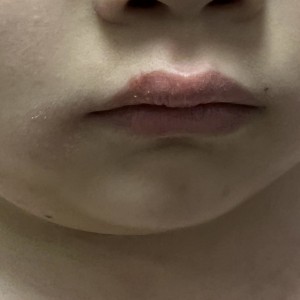 家中小寶貝生唇瘡*